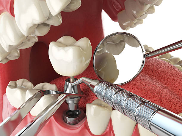 Best Broken or Chipped Tooth Repair in Meadow Lake, NM